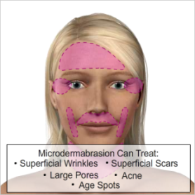 Natural Skin Care on Microdermabrasion   Skin Care By Donna  An Organic Skin Spa